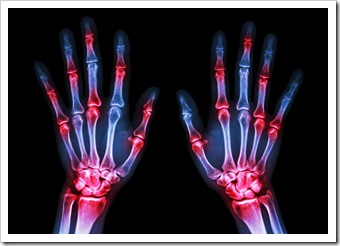 Rheumatoid Arthritis Solutions Jackson MS