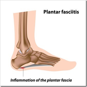 Foot Pain Jackson MS Plantar Fasciitis
